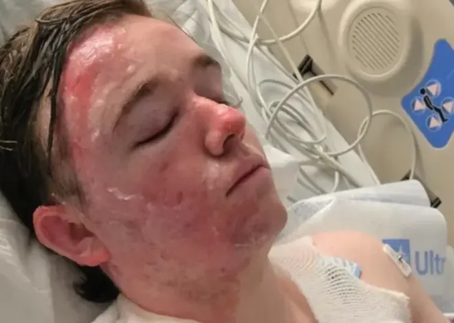 McDonald’s worker suffers severe burns on face and body after coworker throws hot oil on him, family says
