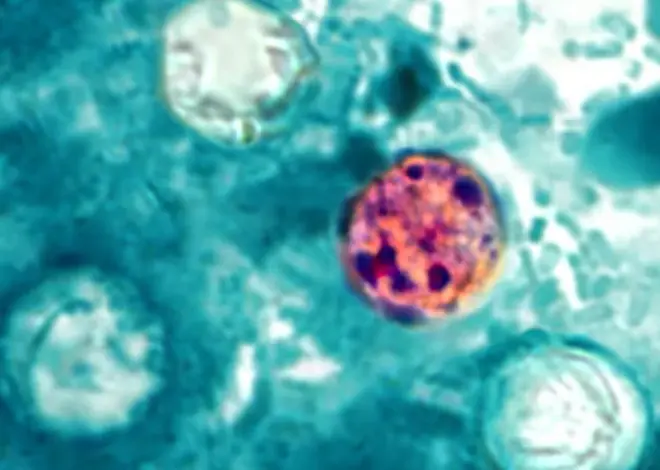 Nearly 7,000 cases of cyclosporiasis confirmed or under investigation nationwide, CDC says