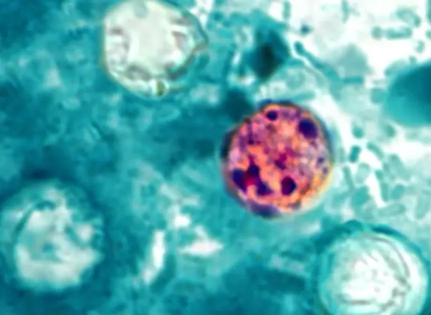 Nearly 7,000 cases of cyclosporiasis confirmed or under investigation nationwide, CDC says