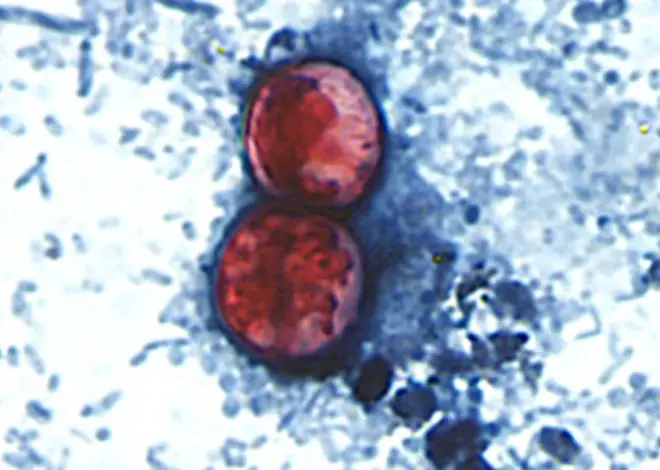 Lettuce may be tip of the iceberg as cyclosporiasis spreads