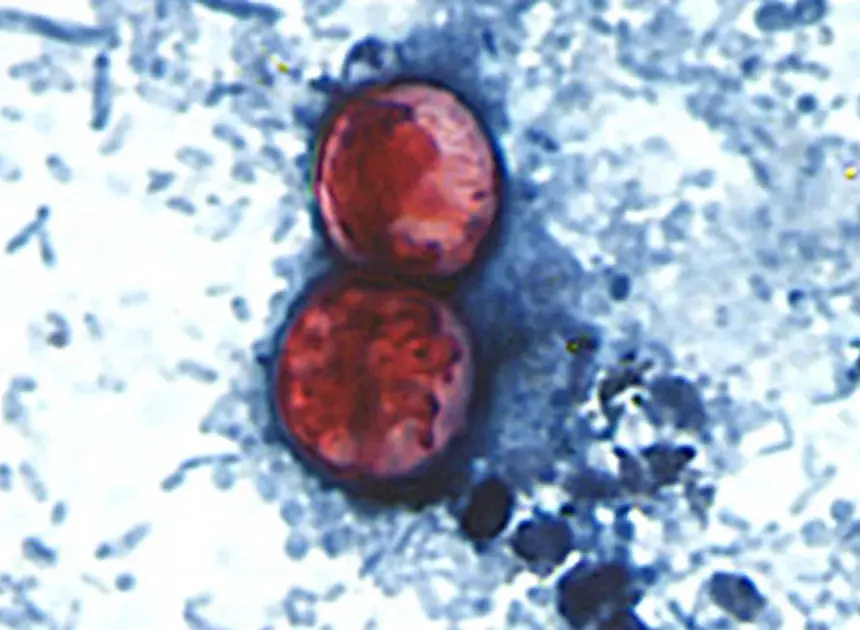 Lettuce may be tip of the iceberg as cyclosporiasis spreads