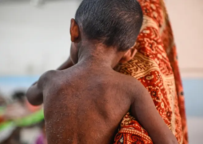 Suspected measles cases kill nearly 1,000 as Bangladesh struggles to contain outbreak