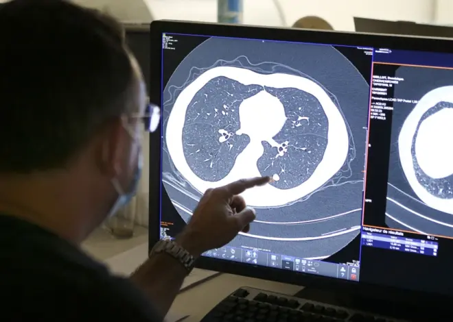 Newly approved pancreatic cancer drug shows promise in lung cancer