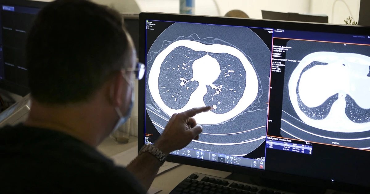 Newly approved pancreatic cancer drug shows promise in lung cancer